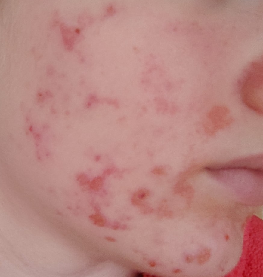 Before — cheek and jaw skin documentation