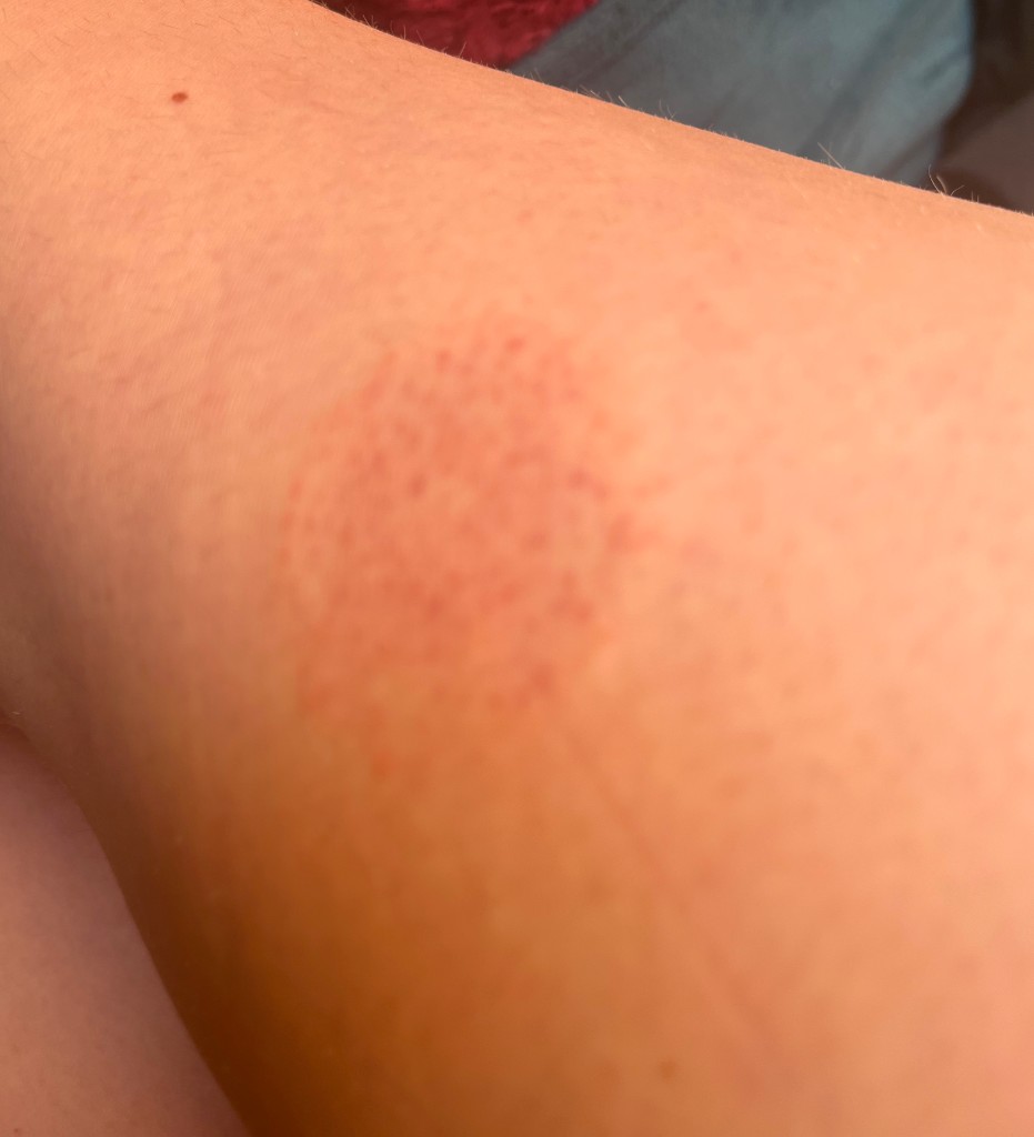 After — closer detail photo of the same skin concern on the thigh