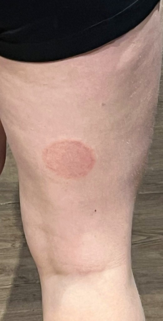 Before — wider context photo of affected skin on the thigh